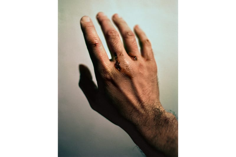 Close-up photograph of an injured hand casting a dark shadow on a pale wall